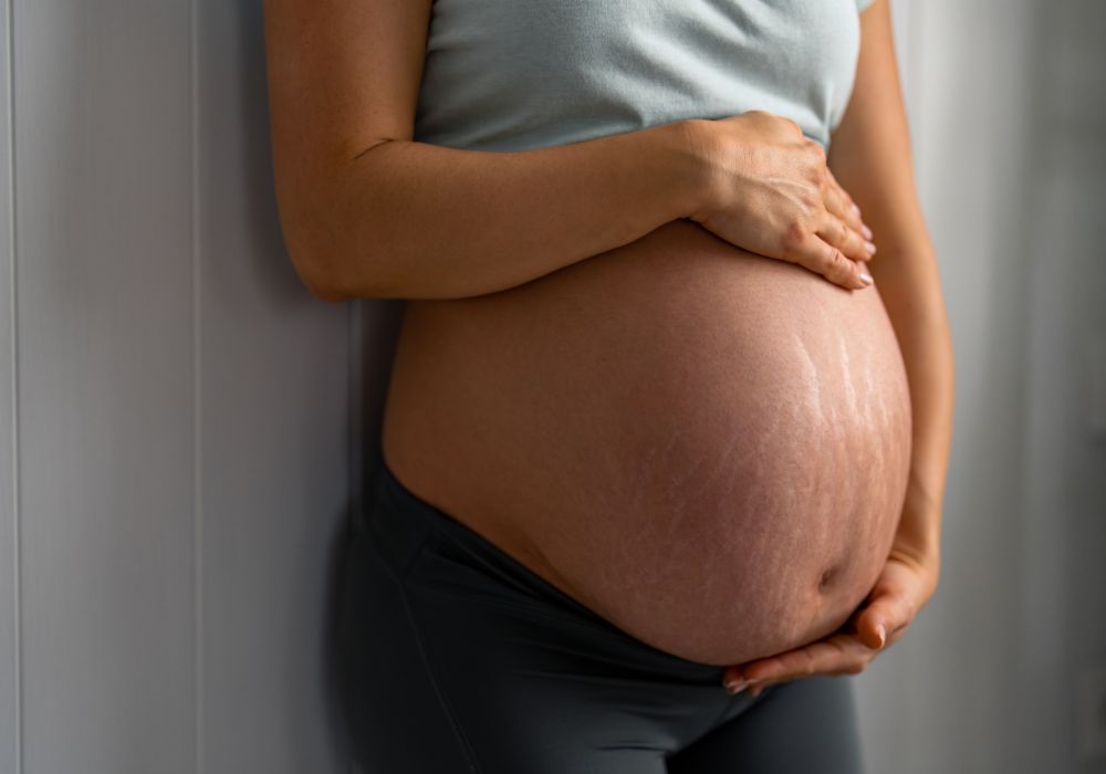 Estrias Como Prevenir Estrias na Gravidez – Dicas Infalíveis