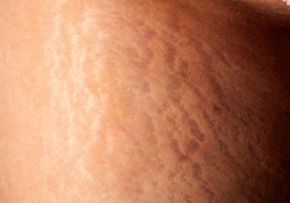 Estrias O Que São, Por Que Aparecem e Como Tratar de Forma Eficaz