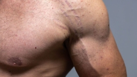 Estrias no Ganho de Massa Muscular Como Prevenir