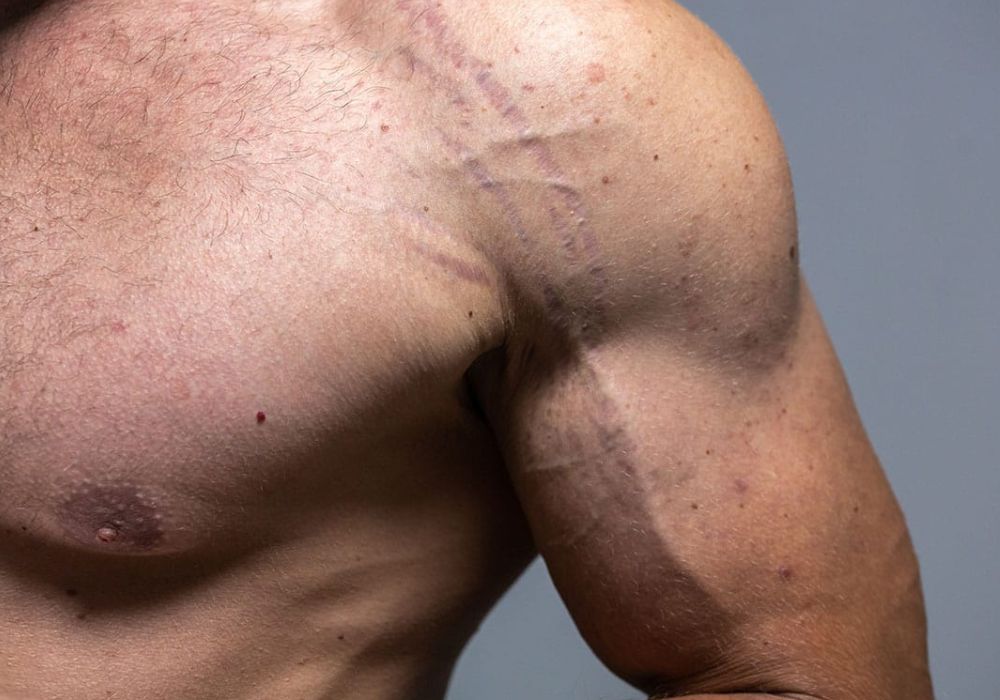 Estrias no Ganho de Massa Muscular Como Prevenir