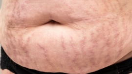 Melhores Produtos para Tratar Estrias Vermelhas Guia Completo 2025