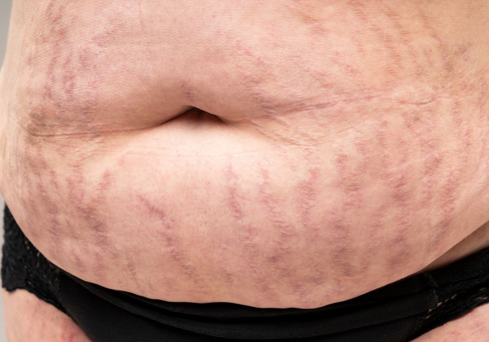 Melhores Produtos para Tratar Estrias Vermelhas Guia Completo 2025