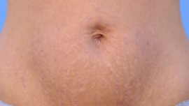 Melhores Tratamentos Estéticos para Eliminar Estrias