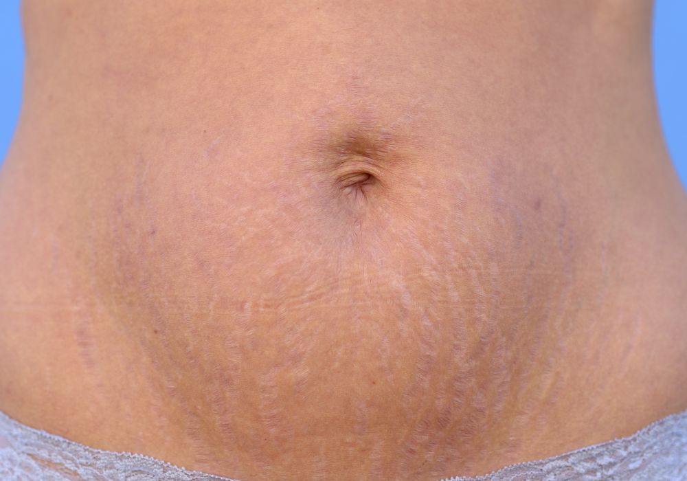 Melhores Tratamentos Estéticos para Eliminar Estrias