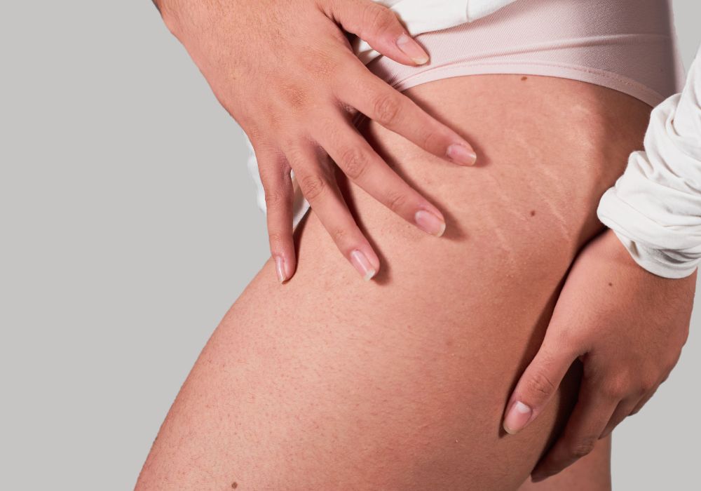 Peeling Químico para Estrias Preço Médio e Como Age na Pele