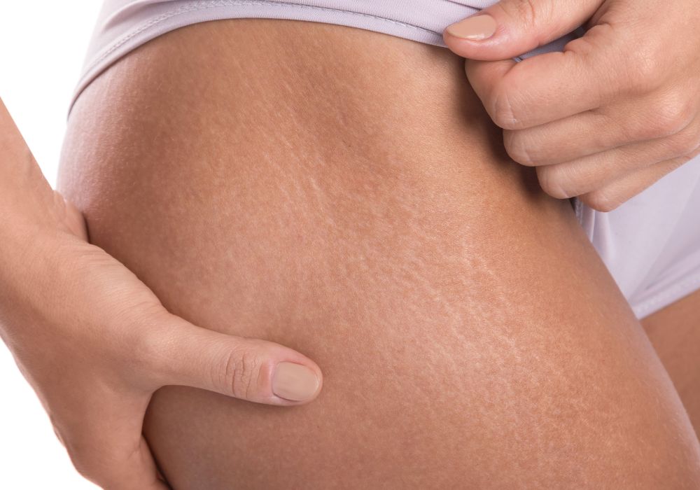 Peeling Químico para Estrias Preço Médio no Brasil