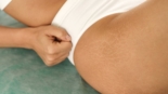Melhor Opção para Tratar Estrias Profundas sem Cirurgia