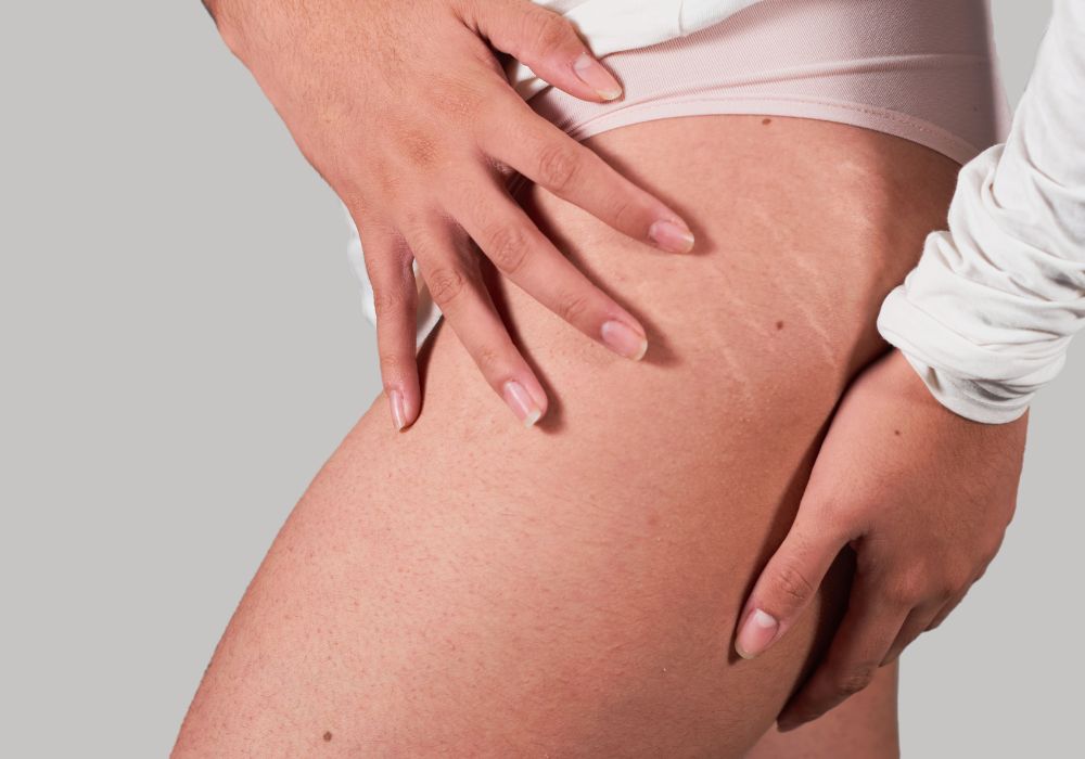 Melhores Cremes para Estrias no Bumbum e Coxas