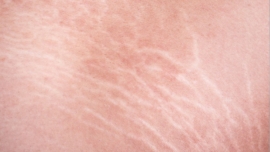 Qual é o melhor tratamento para estrias brancas?