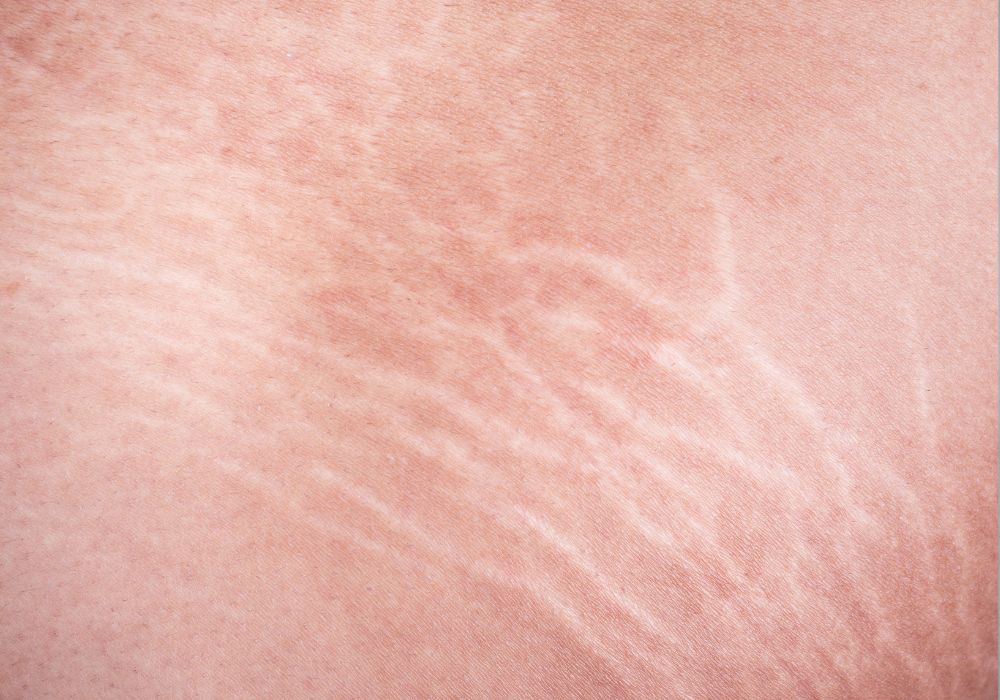 Qual é o melhor tratamento para estrias brancas?