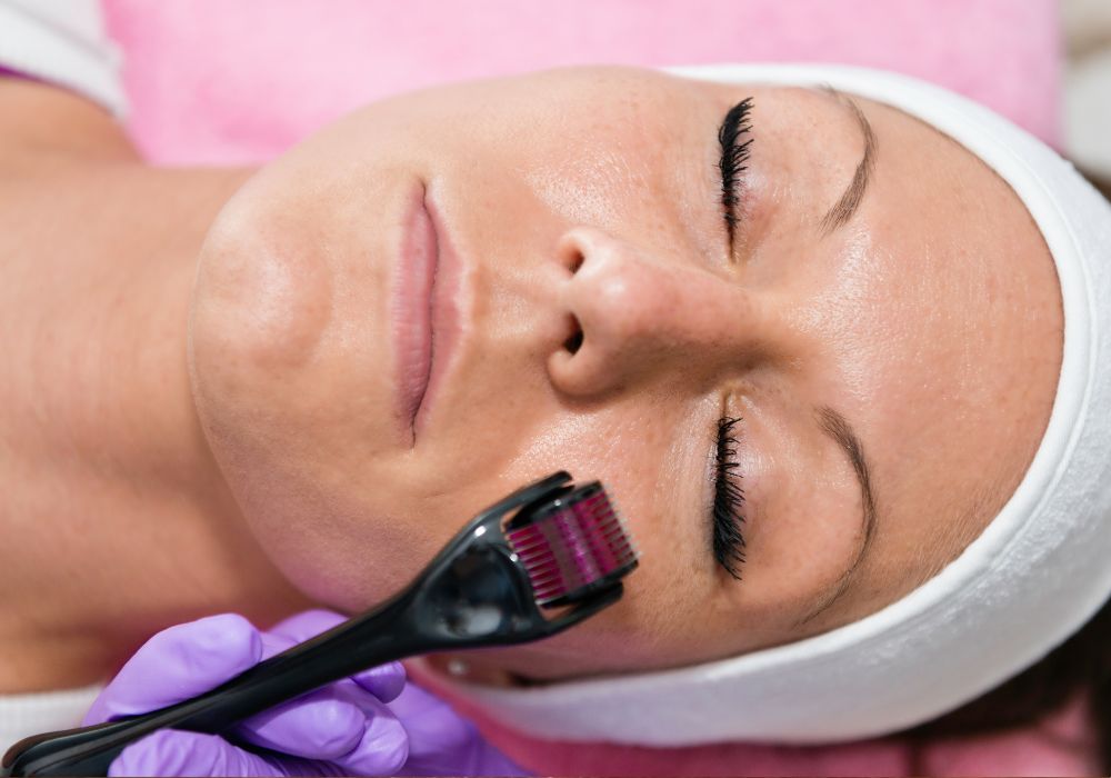 Dermaroller para Estrias Como Usar e Quais os Cuidados