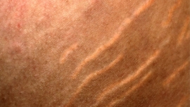 Tretinoína (Ácido Retinóico) para Estrias Vermelhas O Que Você Precisa Saber