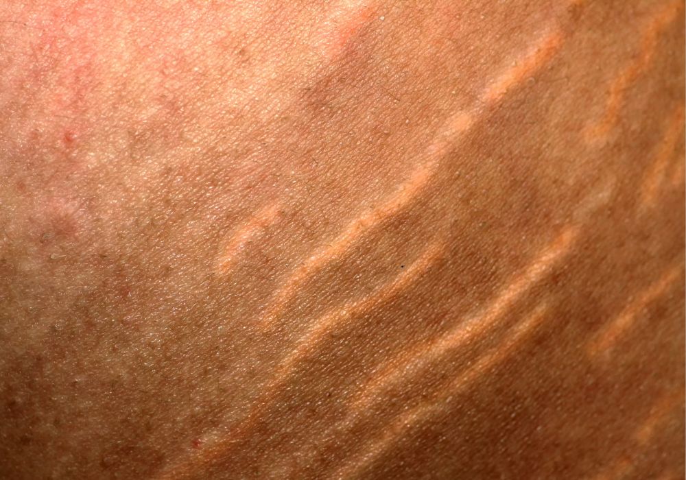 Tretinoína (Ácido Retinóico) para Estrias Vermelhas O Que Você Precisa Saber