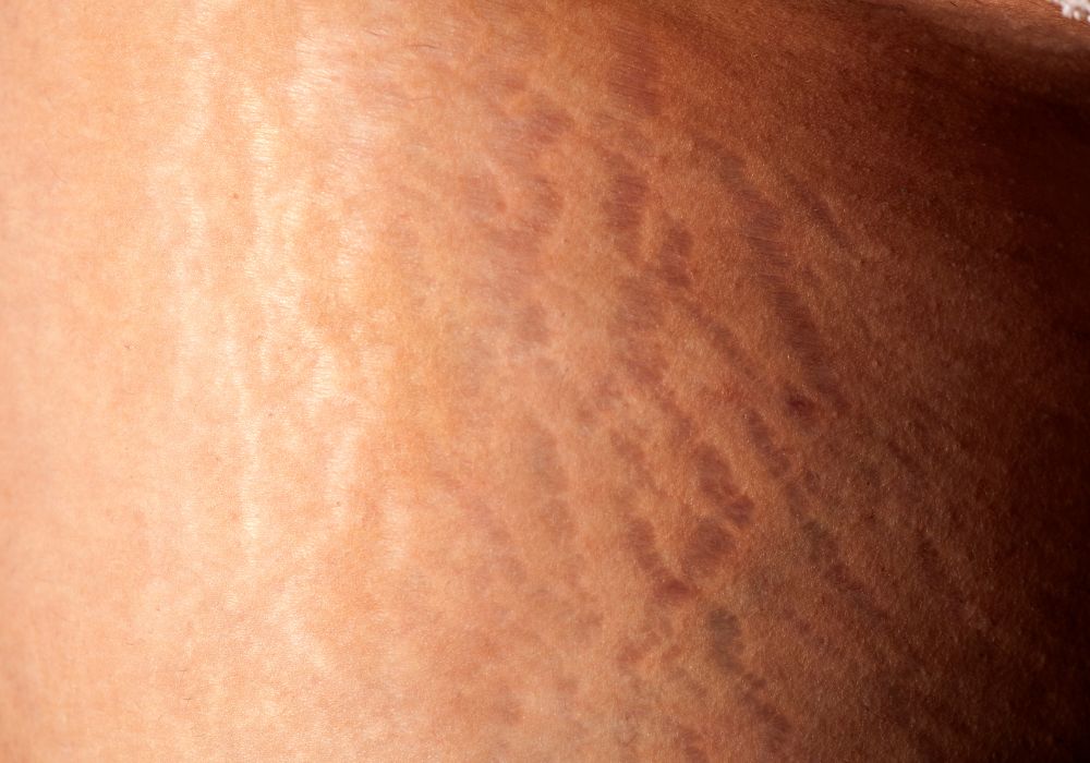 5 Produtos Eficazes para Estrias que Você Pode Usar em Casa