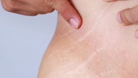 Procedimento para Tirar Estrias Valores, Opções e Resultados