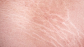 Qual o Melhor Tratamento de Estrias em Casa Guia Completo para Suavizar as Marcas