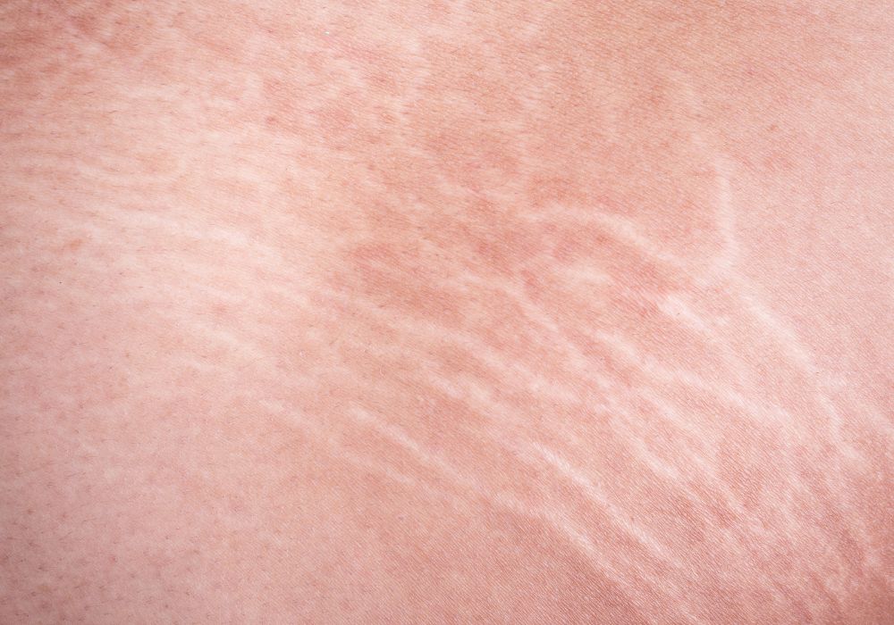 Qual o Melhor Tratamento de Estrias em Casa Guia Completo para Suavizar as Marcas