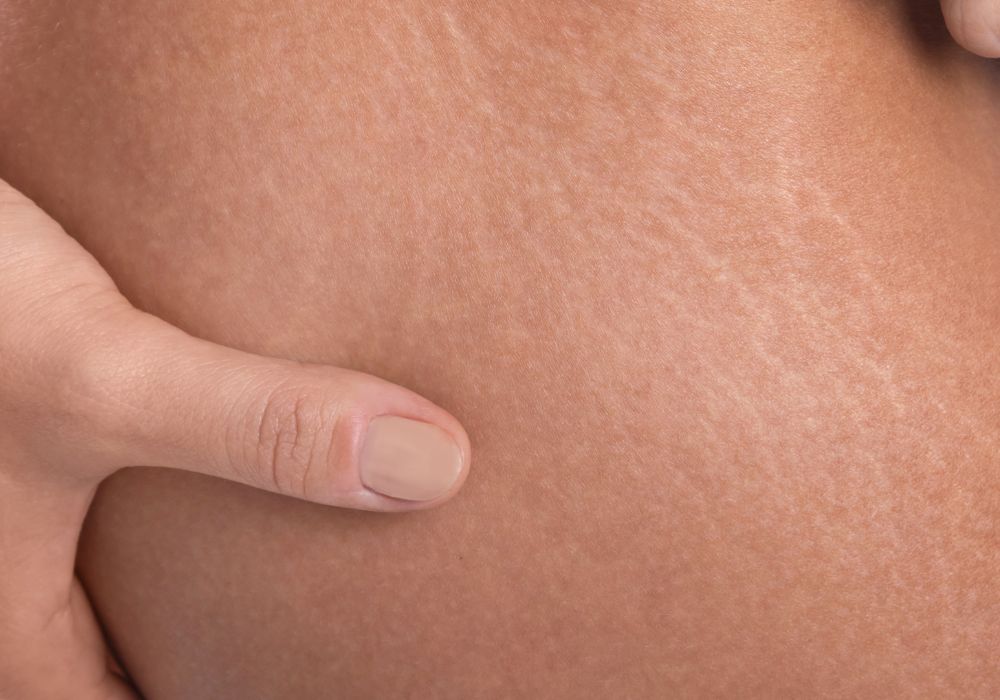 Quanto custa tratar estrias de forma completa